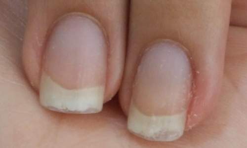 Unhas descamando - O que fazer?! - 01