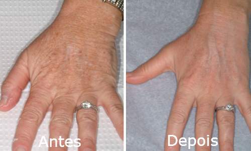 5 Dicas para combater o envelhecimento das mãos rejuvenecimento mãos